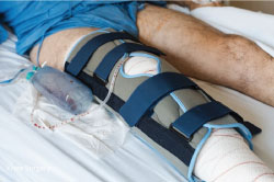 250×166—Knee-Recovery